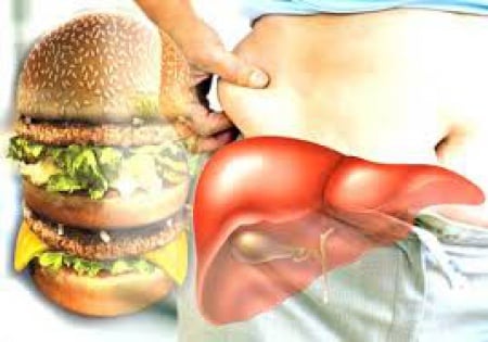 รู้จักโรคไขมันพอกตับ  ปัจจุบัน ประเทศไทย พบภาวะไขมันพอกตับได้มากขึ้นตามแนวโน้มที่เพิ่มขึ้นของภาวะเมตาโบลิกซินโดรม(Metabolic Syndrome) ซึ่งได้แก่ โรคเบาหวาน ความดันโลหิตสูง และไขมันในโลหิตสูงซึ่งมักจะเกิดขึ้นในวัยกลางคนอายุประมาณ 45 ถึง 50 ปีขึ้นไป ที่อัตราการเผาผลาญอาหารเริ่มลดลง