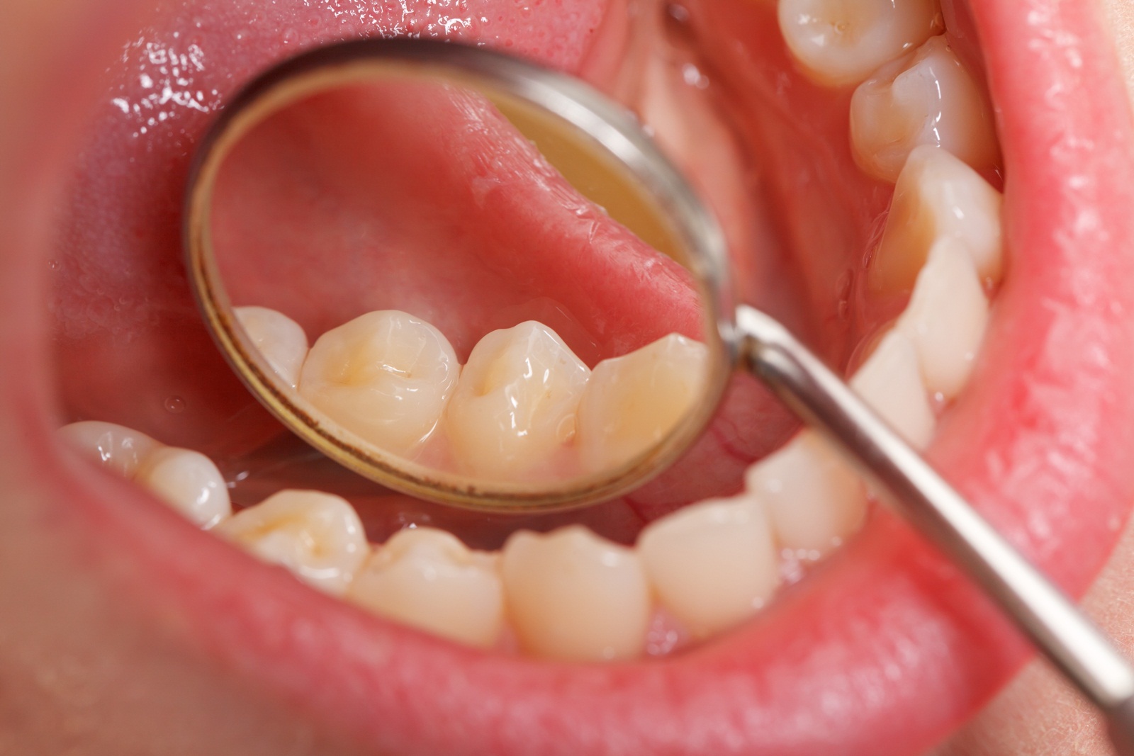 ห่วงรักษาหมอฟันเถื่อนเสี่ยงติดเชื้อ thaihealth