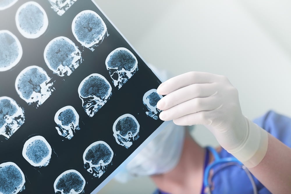 เรียนรู้ดูแลผู้ป่วยโรคหลอดเลือดสมอง thaihealth