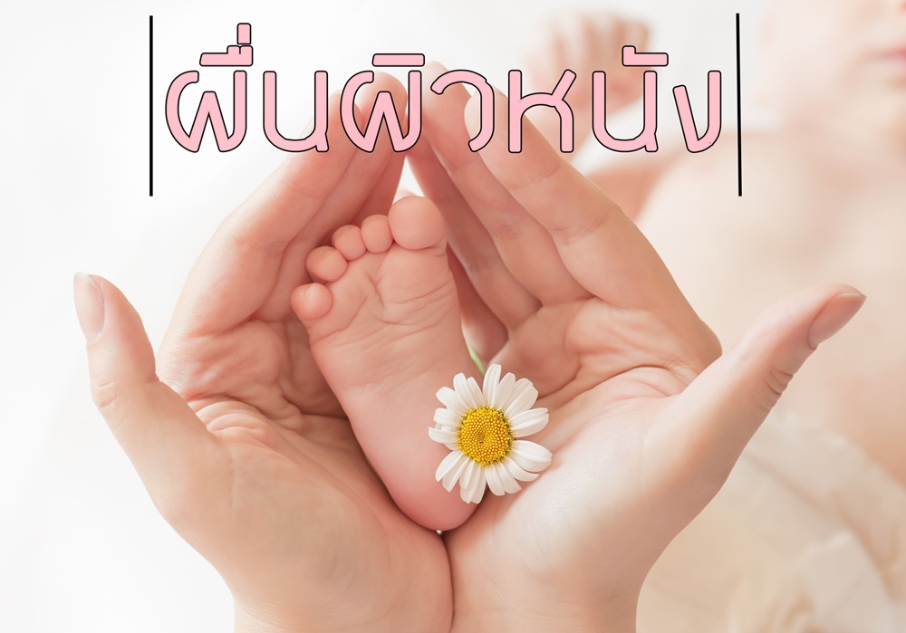 ผื่นผิวหนังในเด็ก thaihealth