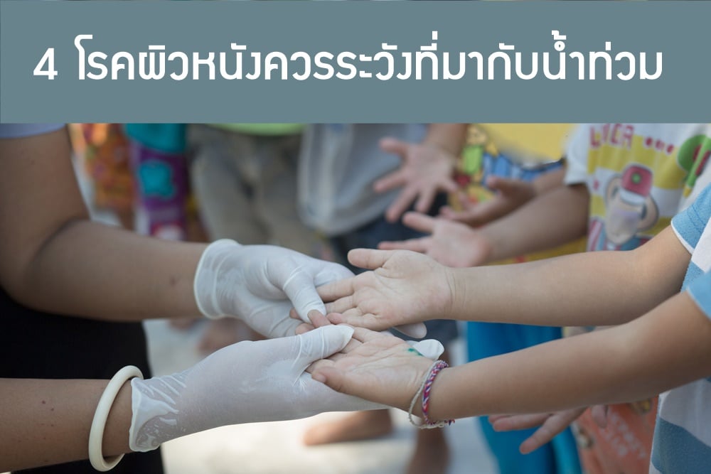4 โรคผิวหนังควรระวังที่มากับน้ำท่วม thaihealth