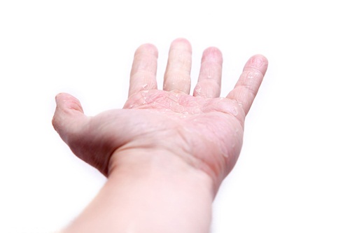มือเท้าปาก ป่วยแล้ว 7 พันราย thaihealth