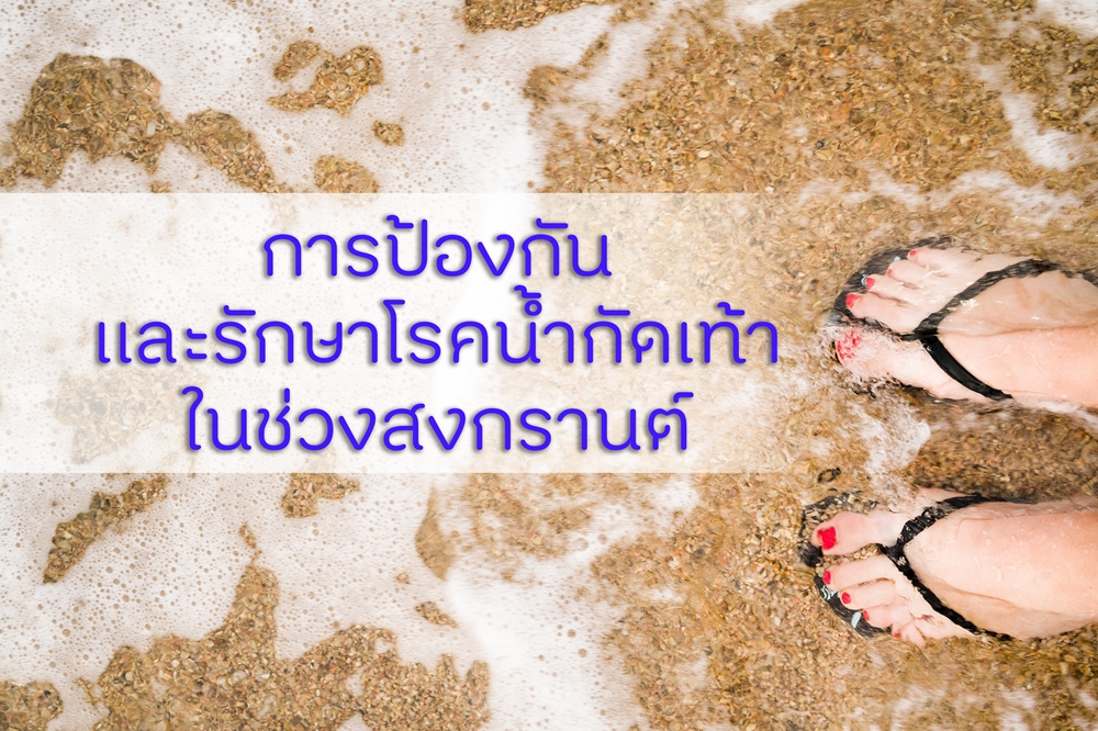 การป้องกันและรักษาโรคน้ำกัดเท้าในช่วงสงกรานต์ thaihealth