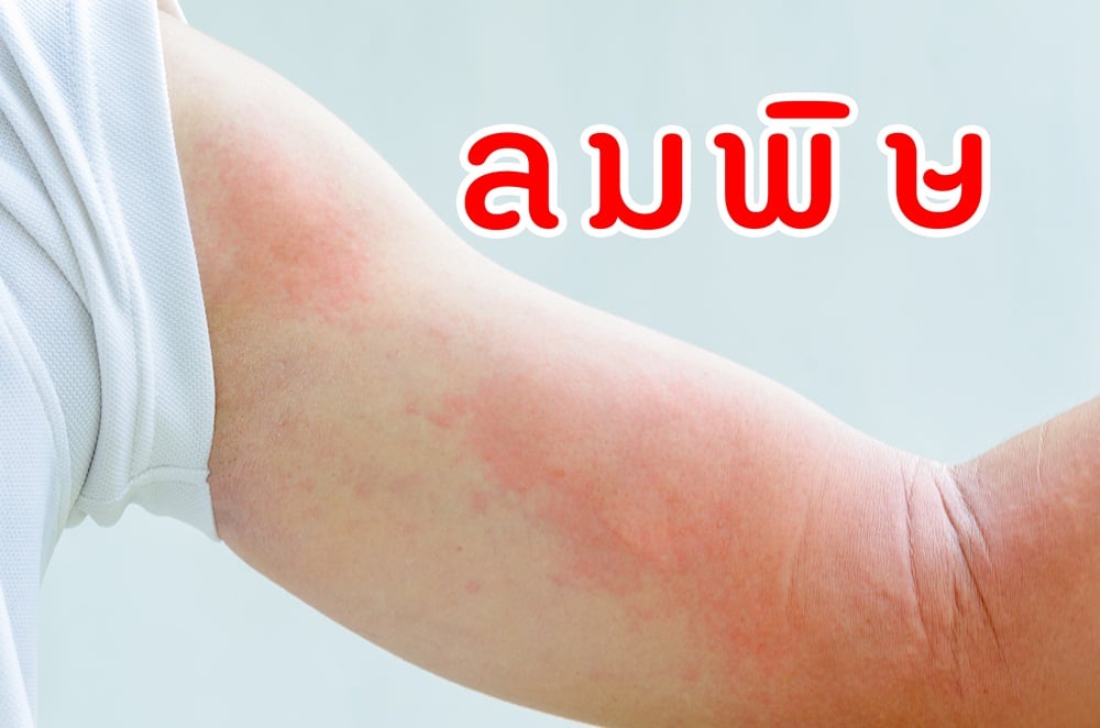 ลมพิษ thaihealth