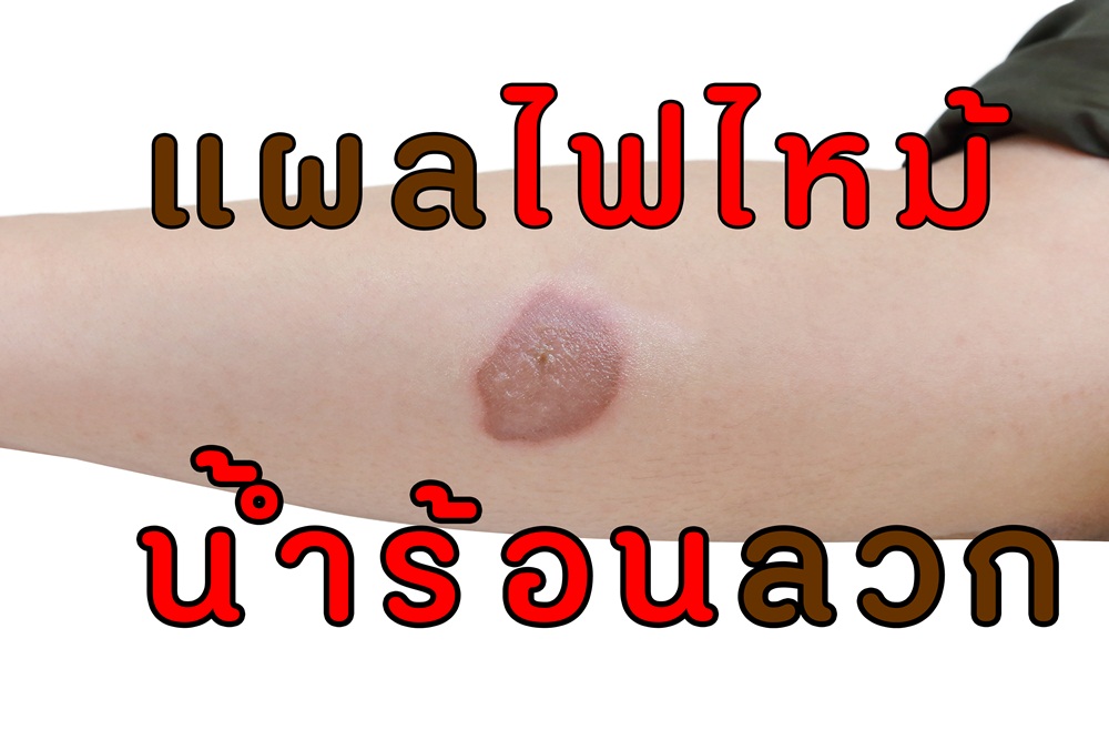 แผลไฟไหม้ น้ำร้อนลวก thaihealth