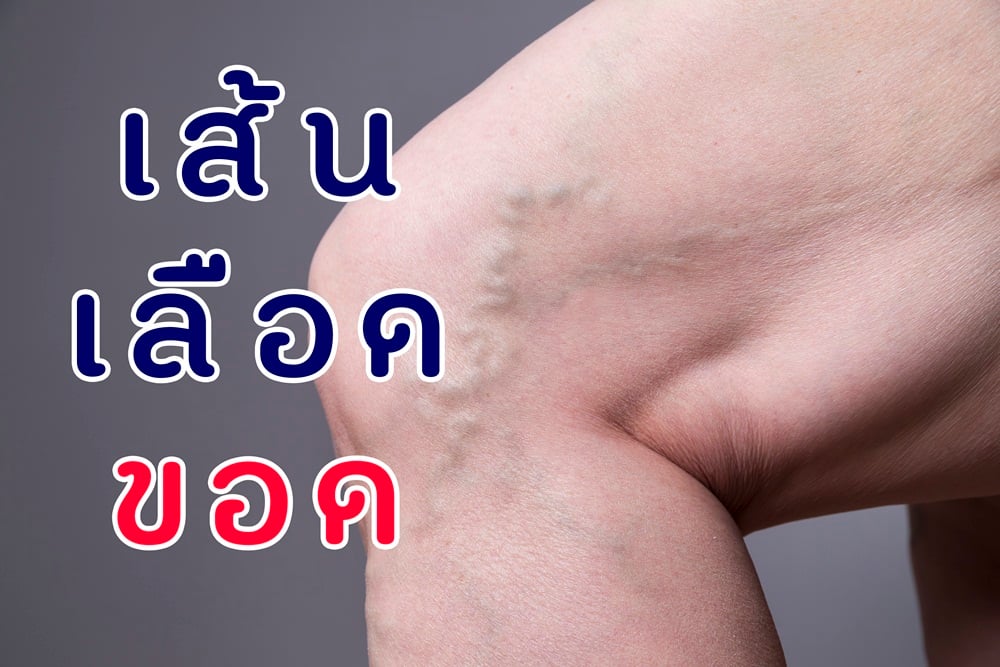  เส้นเลือดขอด thaihealth