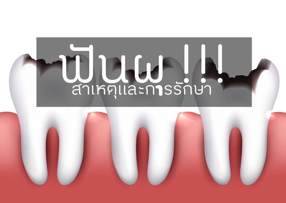 'ฟันผุ' สาเหตุและการรักษา thaihealth