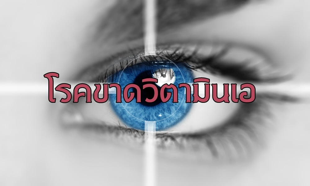 โรคขาดวิตามินเอ - Thaihealth.Or.Th | สำนักงานกองทุนสนับสนุนการสร้าง ...