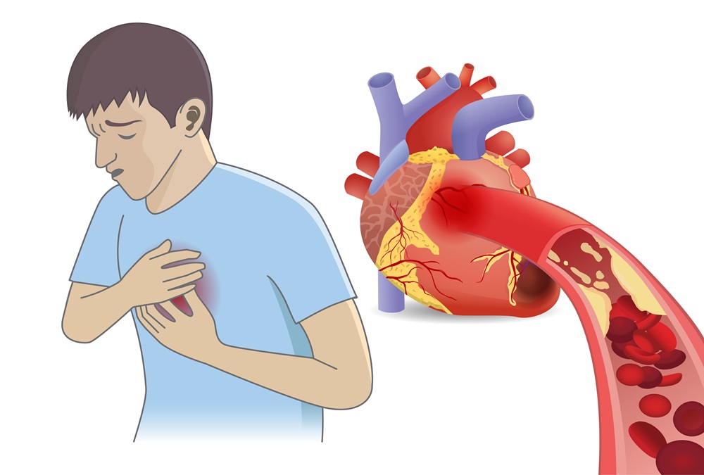 โรคกล้ามเนื้อหัวใจตายเฉียบพลัน เสี่ยงอันตรายถึงชีวิต thaihealth