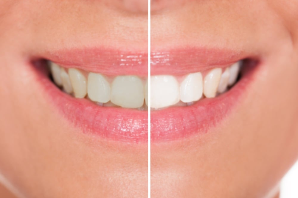 กฎใหม่ ผลิตภัณฑ์ฟอกสีฟันเป็นเครื่องมือแพทย์ thaihealth