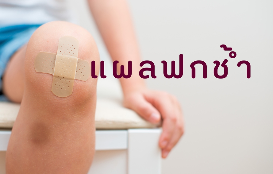 แผลฟกช้ำ thaihealth