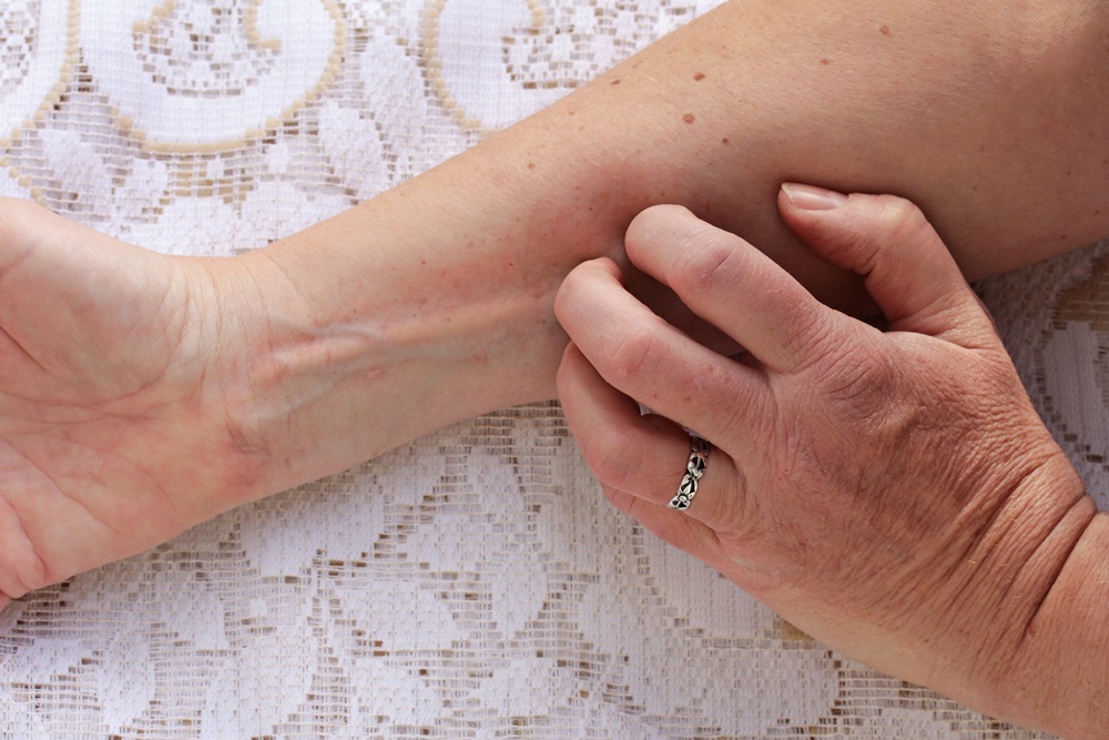 แพทย์เผยวิธีรับมือผื่นผิวหนังอักเสบที่มือ thaihealth