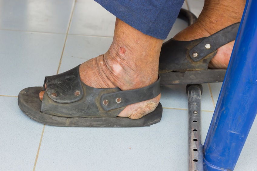 สธ.สงขลาชวนจิตอาสาค้นหาผู้ป่วยโรคเรื้อนรายใหม่ในชุมชน thaihealth
