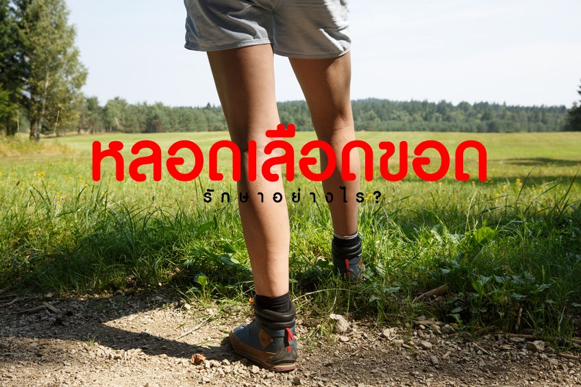 หลอดเลือดขอด รักษาอย่างไร? thaihealth