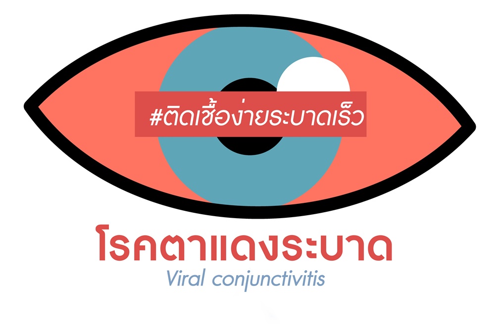 โรคตาแดงระบาด ติดเชื้อง่ายระบาดเร็ว thaihealth