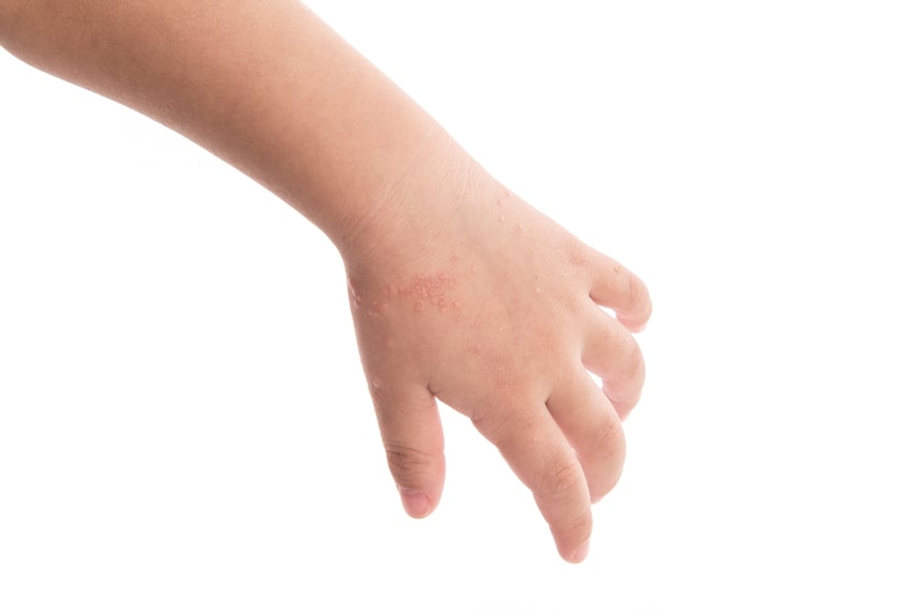 โรคมือเท้าปาก โรคระบาดในเด็กที่ต้องระวัง thaihealth