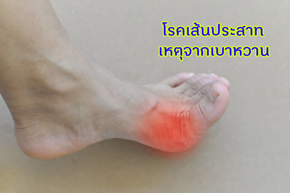 โรคเส้นประสาทเหตุจากเบาหวาน thaihealth