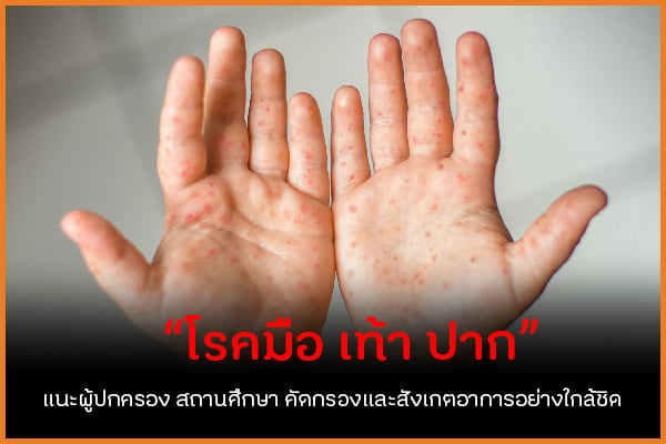 “โรคมือ เท้า ปาก” แนะผู้ปกครอง สถานศึกษา คัดกรองและสังเกตอาการอย่างใกล้ชิด  thaihealth
