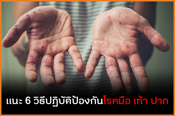แนะ 6 วิธีปฏิบัติป้องกันโรคมือ เท้า ปาก thaihealth