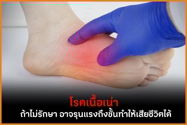โรคเนื้อเน่าถ้าไม่รักษา อาจรุนแรงถึงขั้นทำให้เสียชีวิตได้ thaihealth