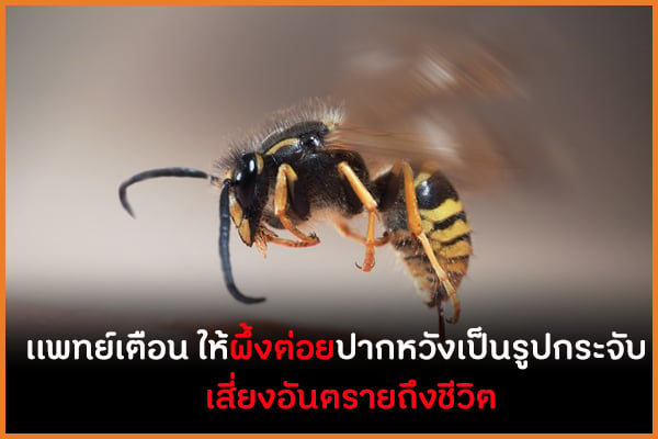 เเพทย์เตือน ให้ผึ้งต่อยปากหวังเป็นรูปกระจับ เสี่ยงอันตรายถึงชีวิต thaihealth