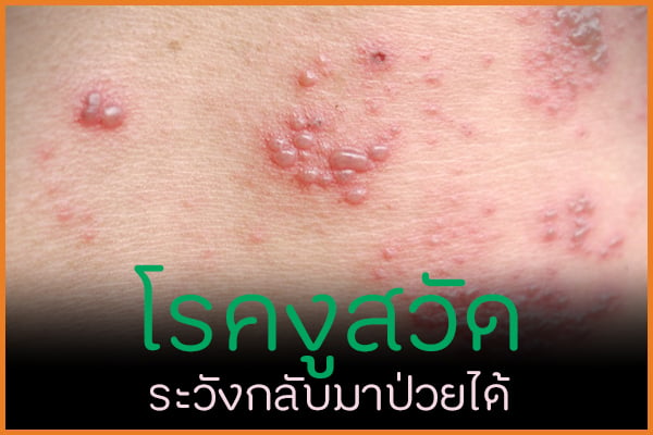 โรคงูสวัด ระวังกลับมาป่วยได้ thaihealth