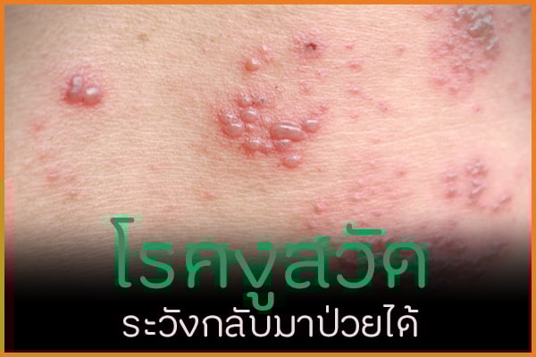 โรคงูสวัด ระวังกลับมาป่วยได้ thaihealth