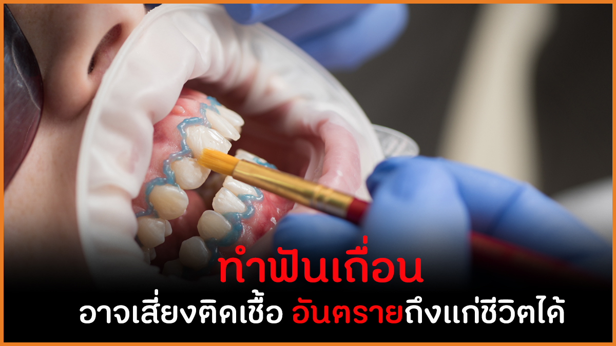 ทำฟันเถื่อน  อาจเสี่ยงติดเชื้อ อันตรายถึงแก่ชีวิตได้  thaihealth