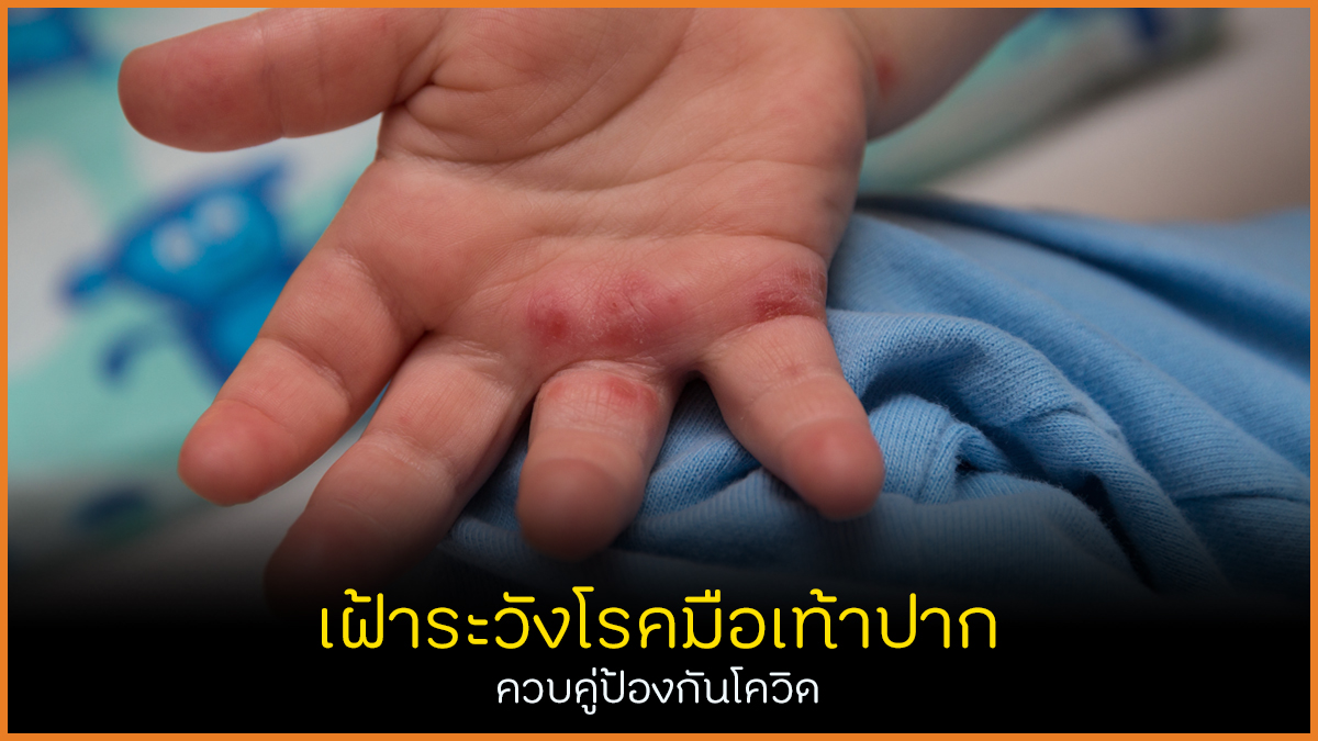 เฝ้าระวังโรคมือเท้าปาก ควบคู่ป้องกันโควิด thaihealth