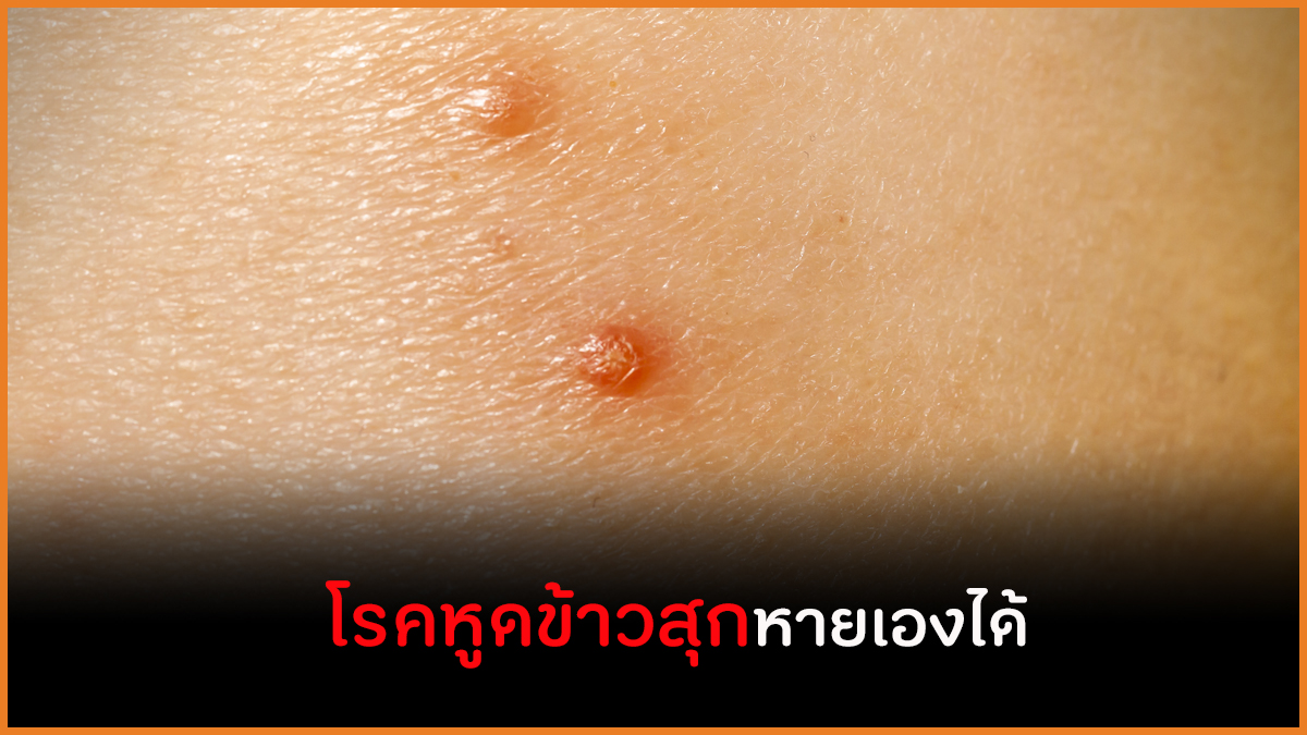โรคหูดข้าวสุกหายเองได้ thaihealth