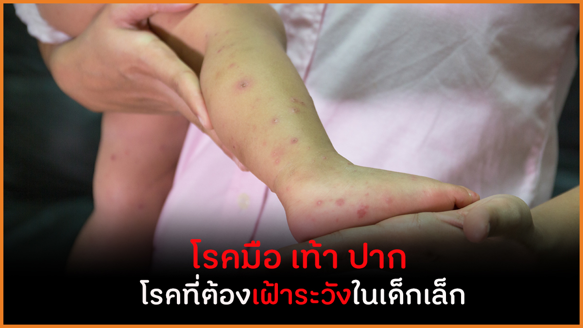 โรคมือ เท้า ปาก  โรคที่ต้องเฝ้าระวังในเด็กเล็ก thaihealth