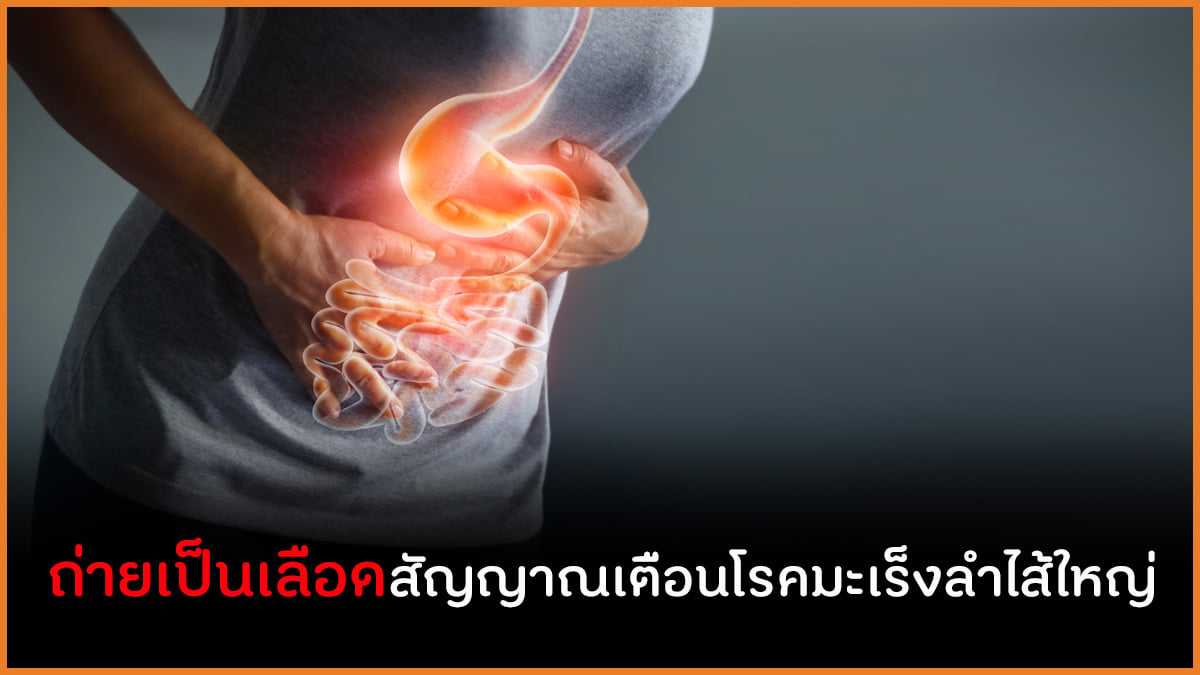 ถ่ายเป็นเลือดสัญญาณเตือนโรคมะเร็งลำไส้ใหญ่ thaihealth