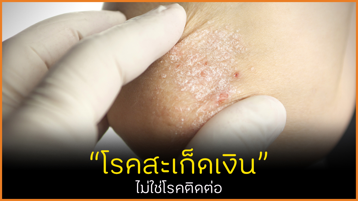 โรคสะเก็ดเงิน ไม่ใช่โรคติดต่อ thaihealth