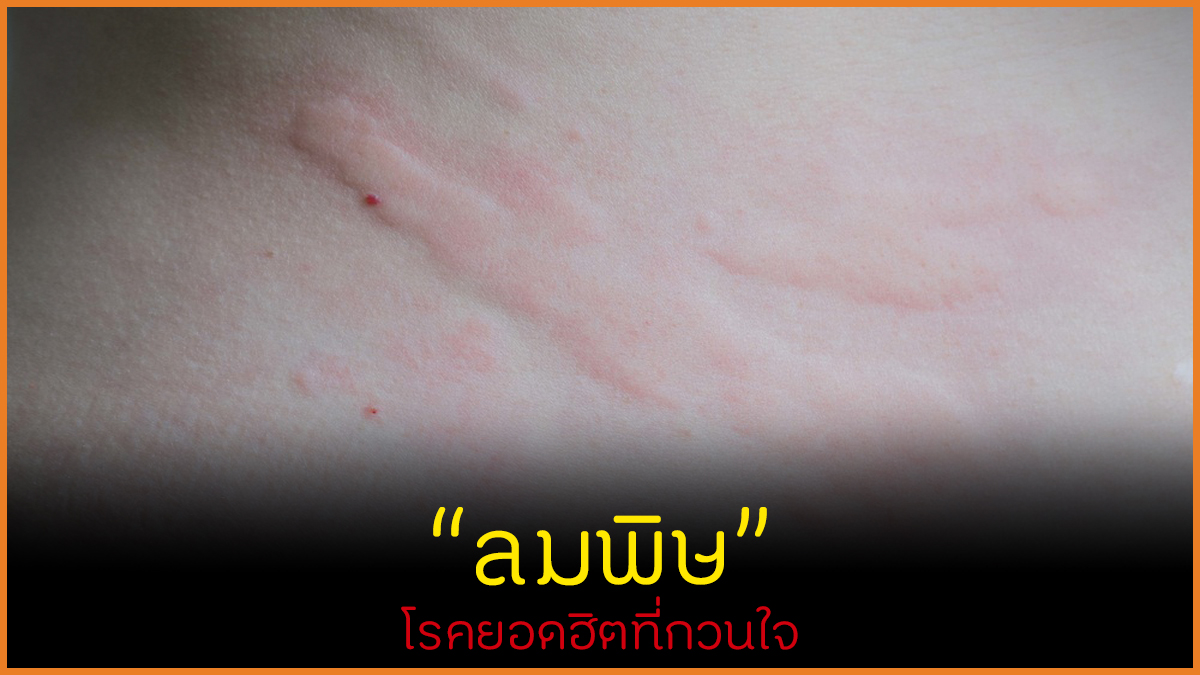 ลมพิษ โรคยอดฮิตที่กวนใจ thaihealth