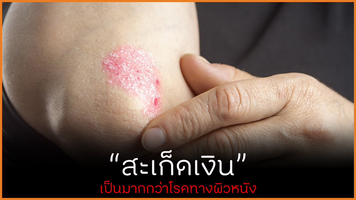 สะเก็ดเงิน เป็นมากกว่าโรคทางผิวหนัง thaihealth