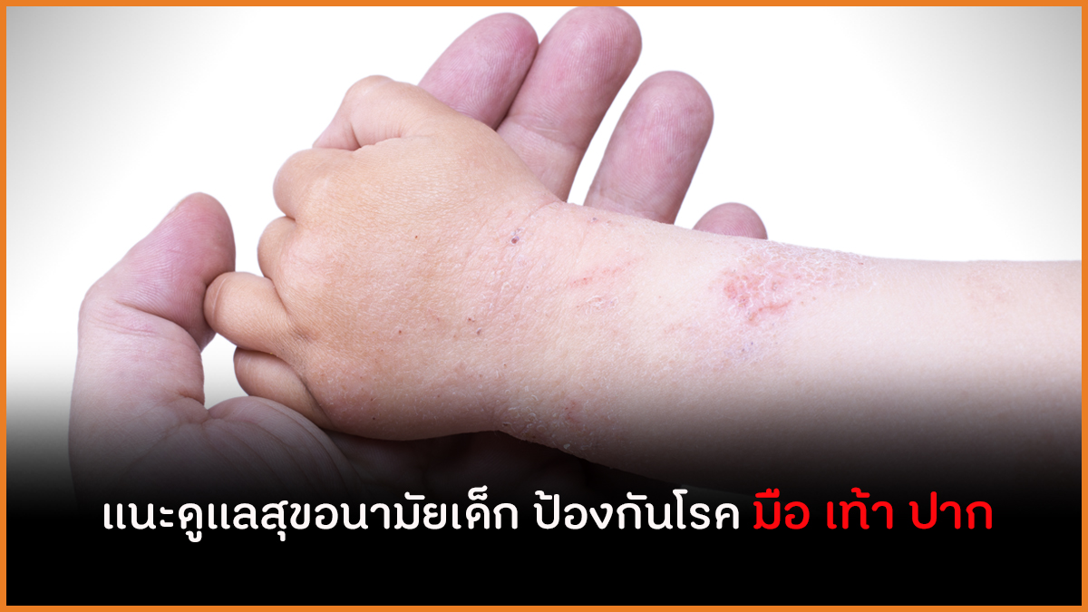 แนะดูแลสุขอนามัยเด็ก ป้องกันโรค มือ เท้า ปาก  thaihealth