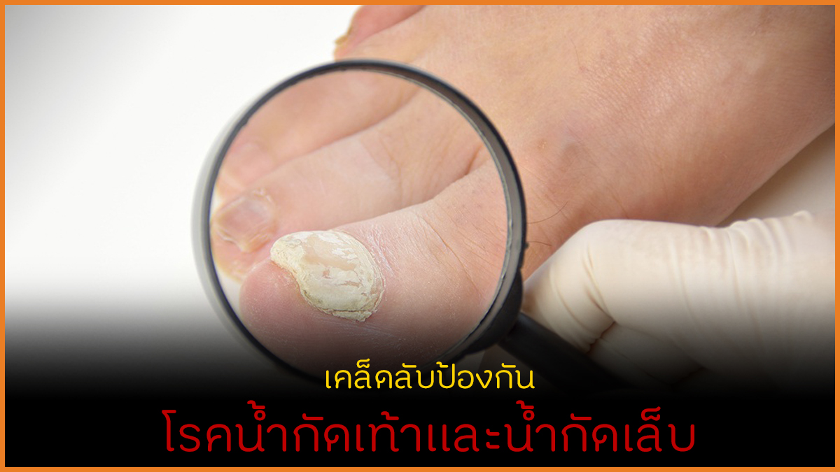 รู้ทันโรคน้ำกัดเท้าและน้ำกัดเล็บ thaihealth
