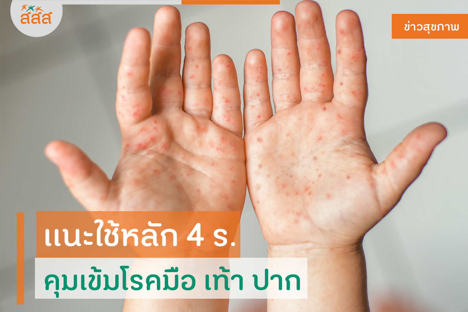 แนะใช้หลัก 4 ร. คุมเข้มโรคมือ เท้า ปาก thaihealth