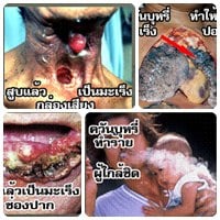 ภาพข้างซองบุหรี่ ของจริงยิ่งกว่าในรูป!!