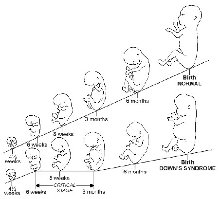 แผนภูมิการเติบโตเด็กดาวน์