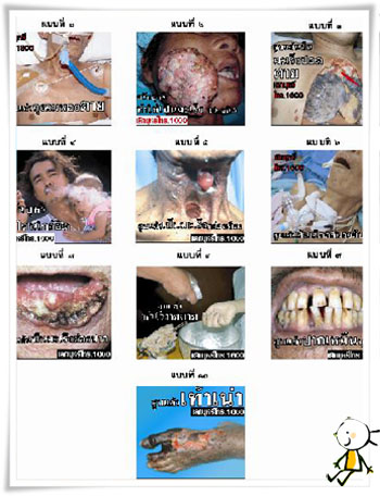 ภาพคำเตือนภัยบุหรี่