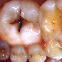 หมอฟันเตือนน้ำผลไม้ปั่นตัวการทำฟันผุ